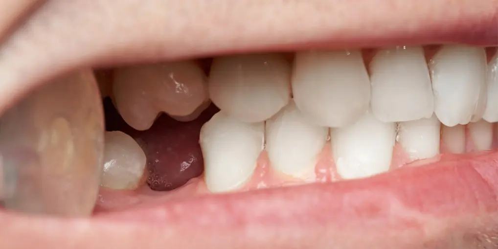 Replacement of missing teeth